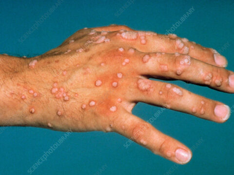 Skin Warts