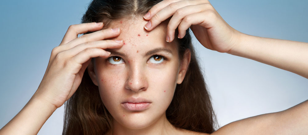 Everything You Want to Know About Acne